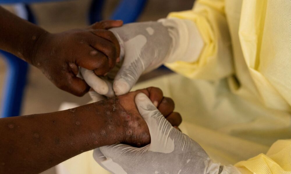 mpox:-saiba-quais-doencas-ja-tiveram-mais-alto-nivel-de-alerta-global